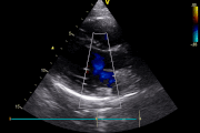 Echocardiography